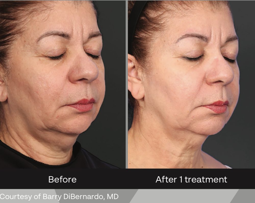 XERF before and after one treatment: jawline and neck tightening