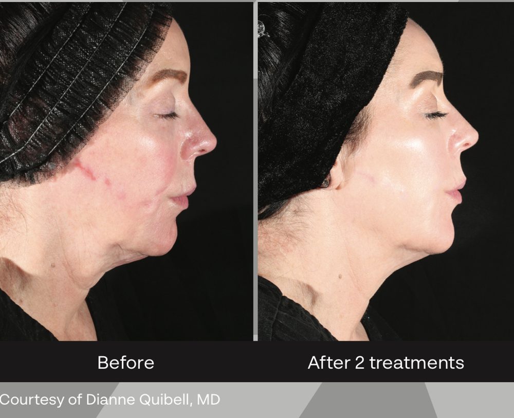 XERF before and after two treatments: lifted jawline and smoother contour